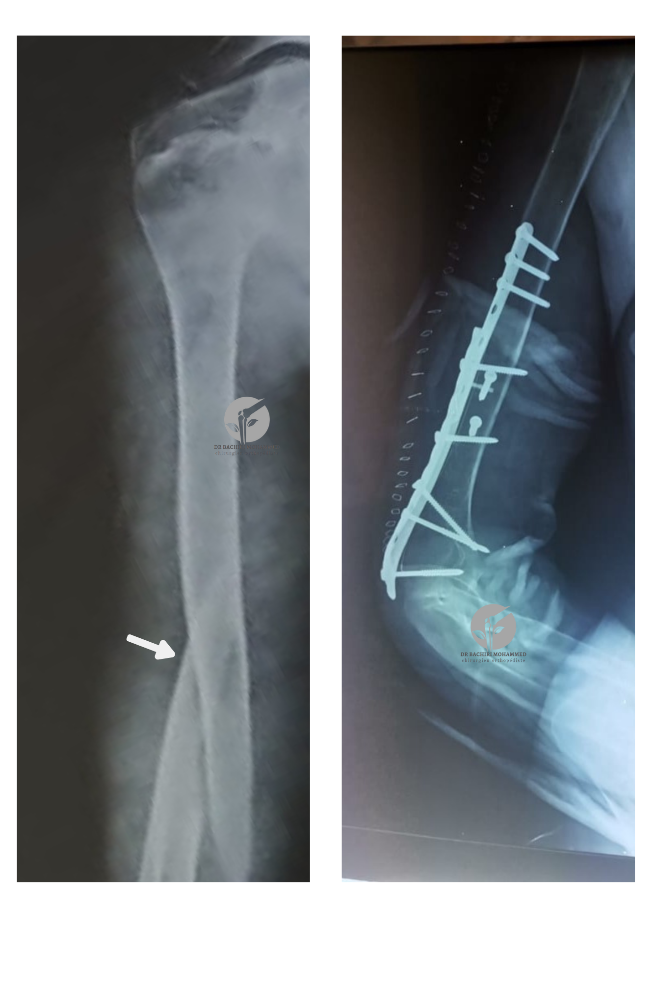Fracture de l'humérus avec double plaque vissée par Dr. Bachiri Mohammed à Oujda
